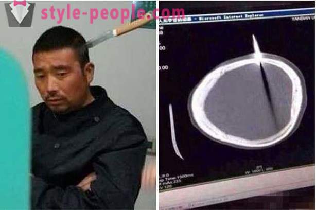 Kinez s nožem u glavi je otišla liječniku