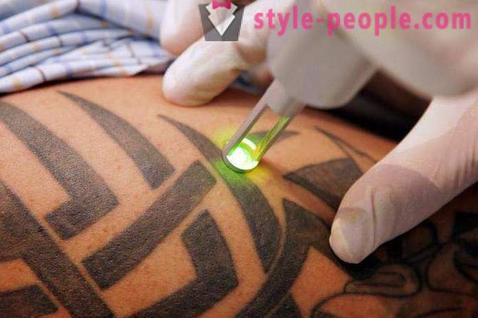 Uklanjanje tetovaža Laser. pregledao