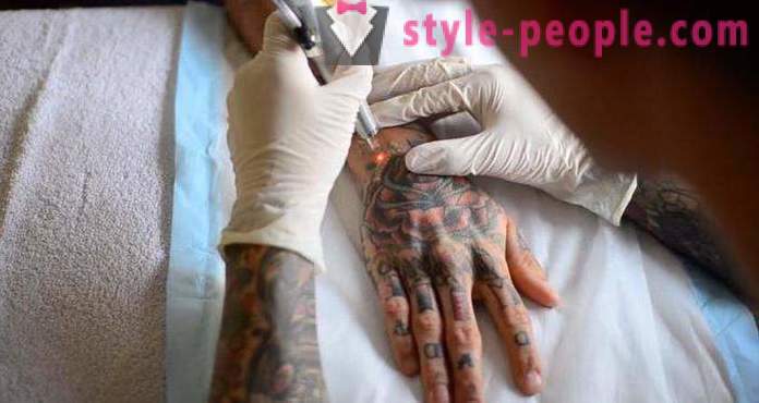 Uklanjanje tetovaža Laser. pregledao