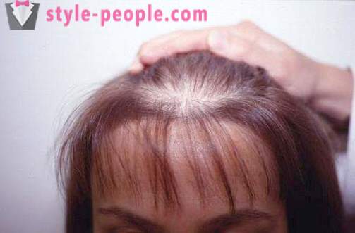 Darsonval kose. Primjena darsonvalya za liječenje i sprječavanje gubitka kose