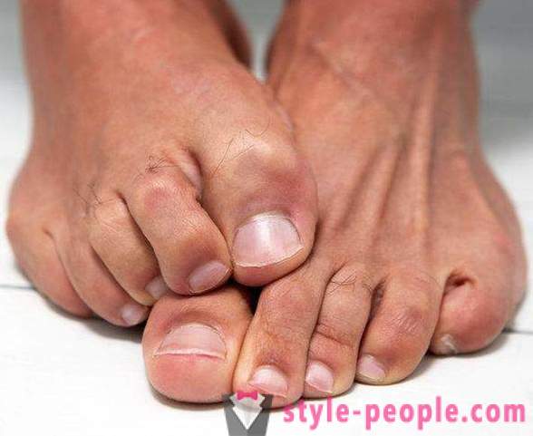 Suha koža na nogama: Uzroci