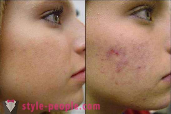 Mi liječiti acne ožiljaka