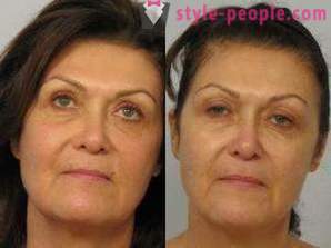 Laser resurfacing lica - siguran način za obnavljanje