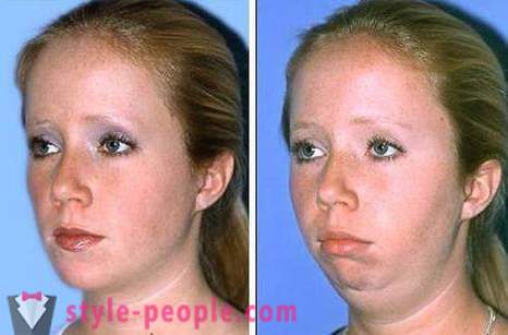 Kako ukloniti obraze bez operacije